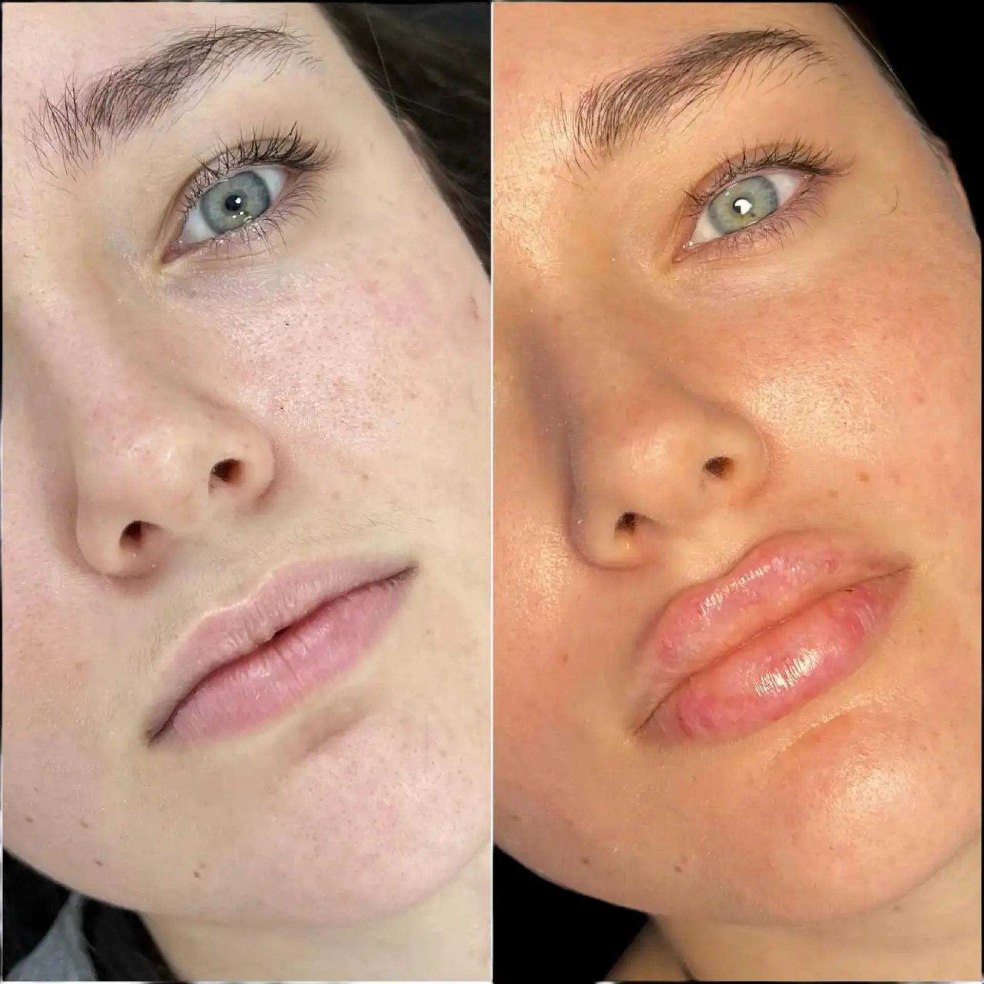 Beauty Solutions at the Best Aesthetic Clinic in Dubai for Fillers