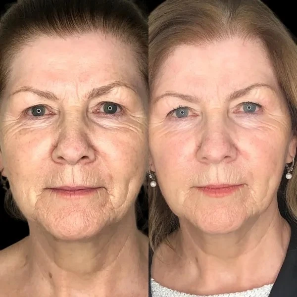 Unlock Profhilo at Best Aesthetic Clinics in dubai