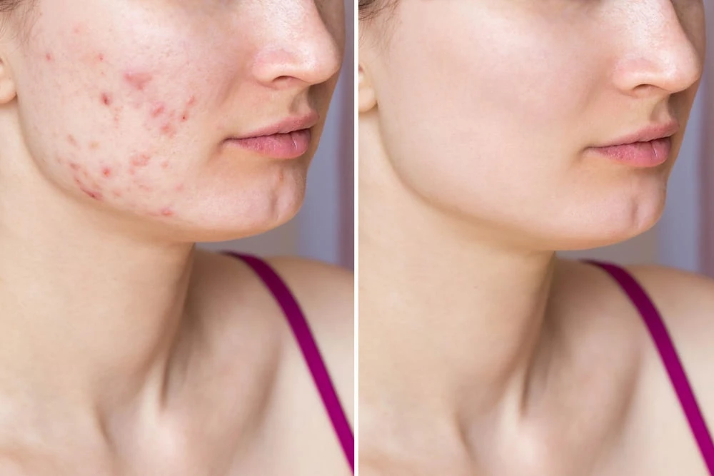 Why Electrolysis Boca Raton Is Safe for All Skin Types