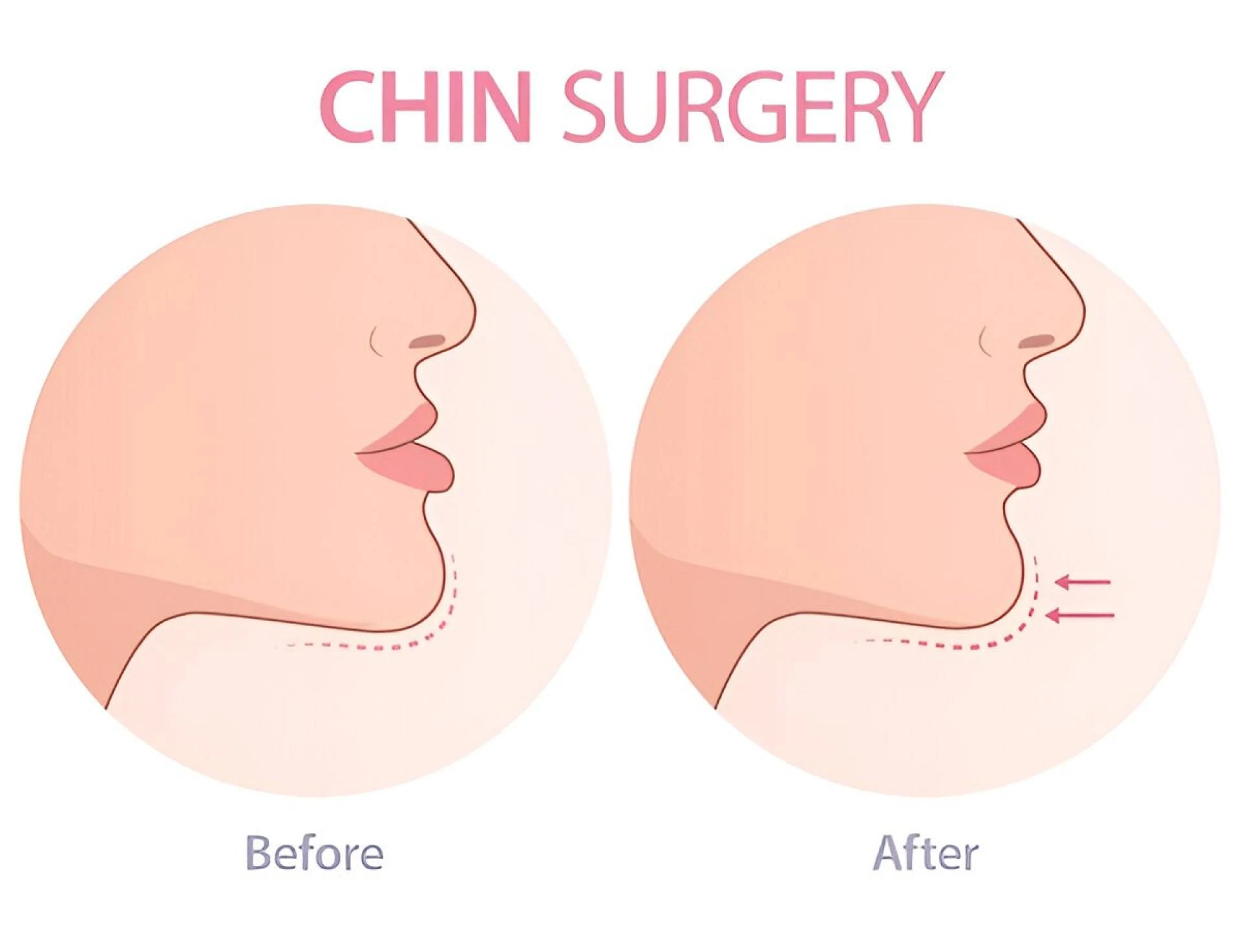 How Chin Surgery Can Transform Facial Balance & Confidence