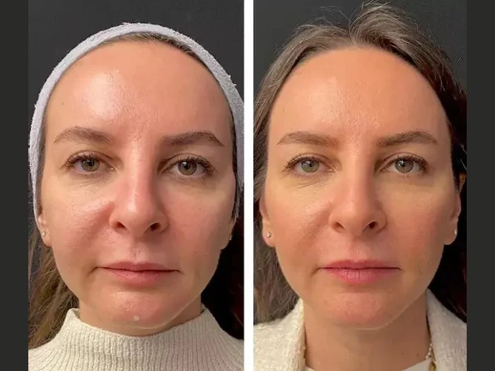 Best Aesthetic Clinics in dubai: Mesotherapy vs Other Skin Treatments