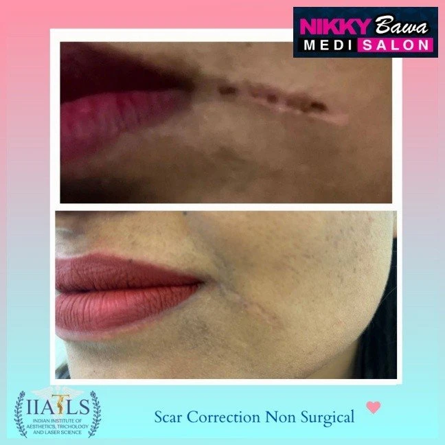 From Laser to Micro needling: Stretch Marks Treatment Options at Bhopal’s Skin Care Clinics