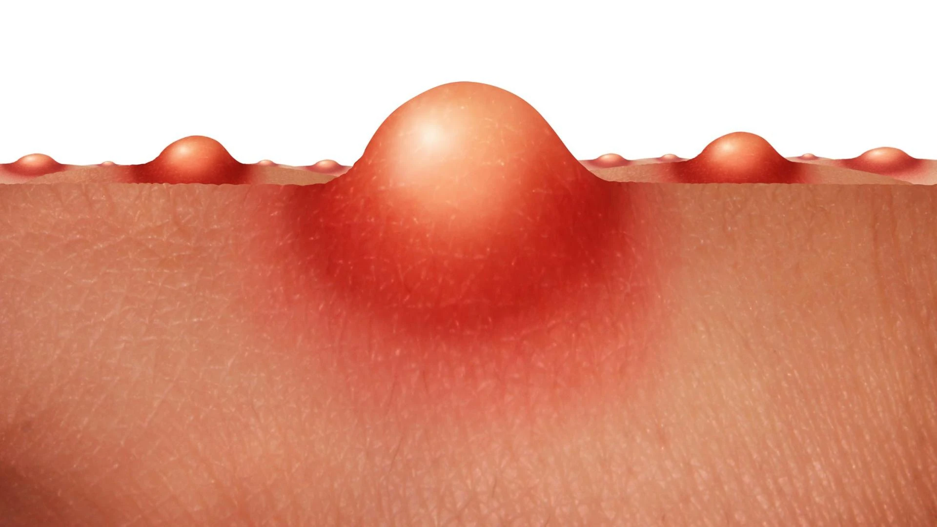 Why Your Breakouts Keep Coming Back—and How Modern Acne Treatment Finally Targets the Root Cause