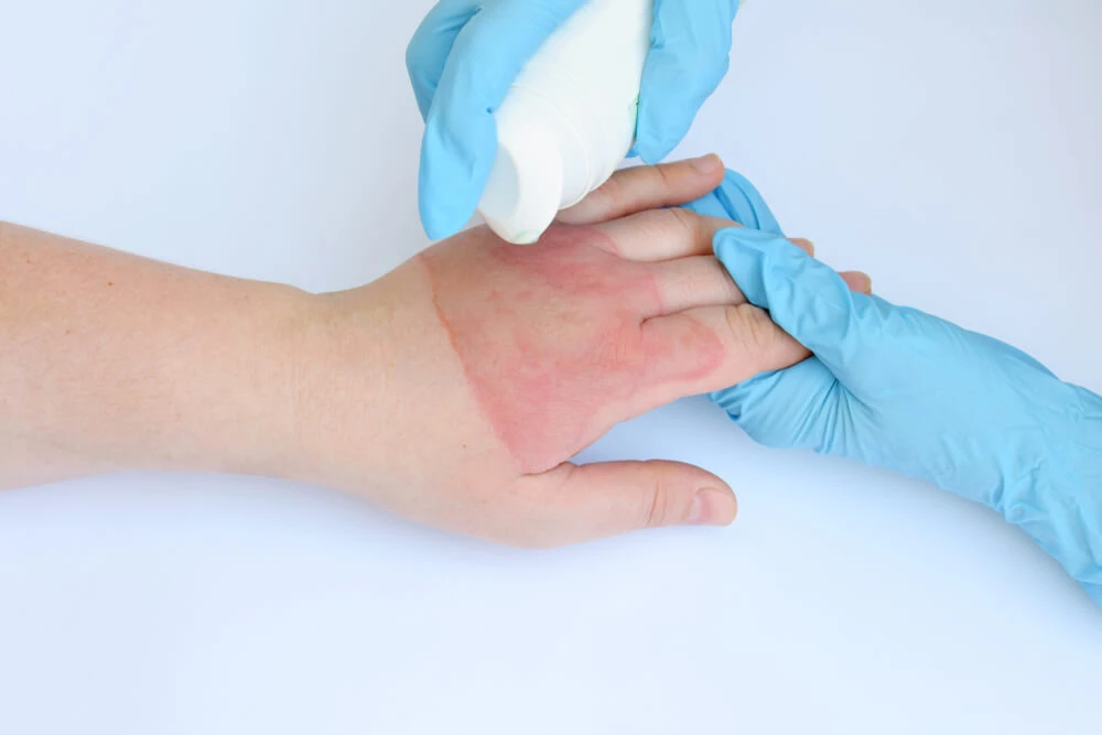 Burn Treatment Care Plans for Mild to Serious Burn Injuries