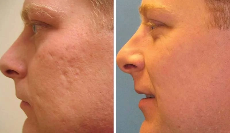 Effective Acne Scar Treatment: Solutions for Smoother, Clearer Skin