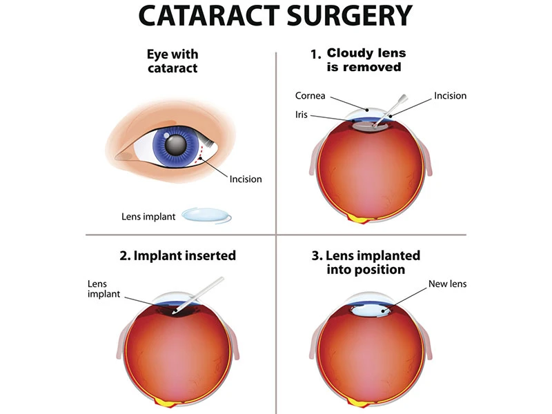 The Best Cataract Lens for Night Vision in 2025-26