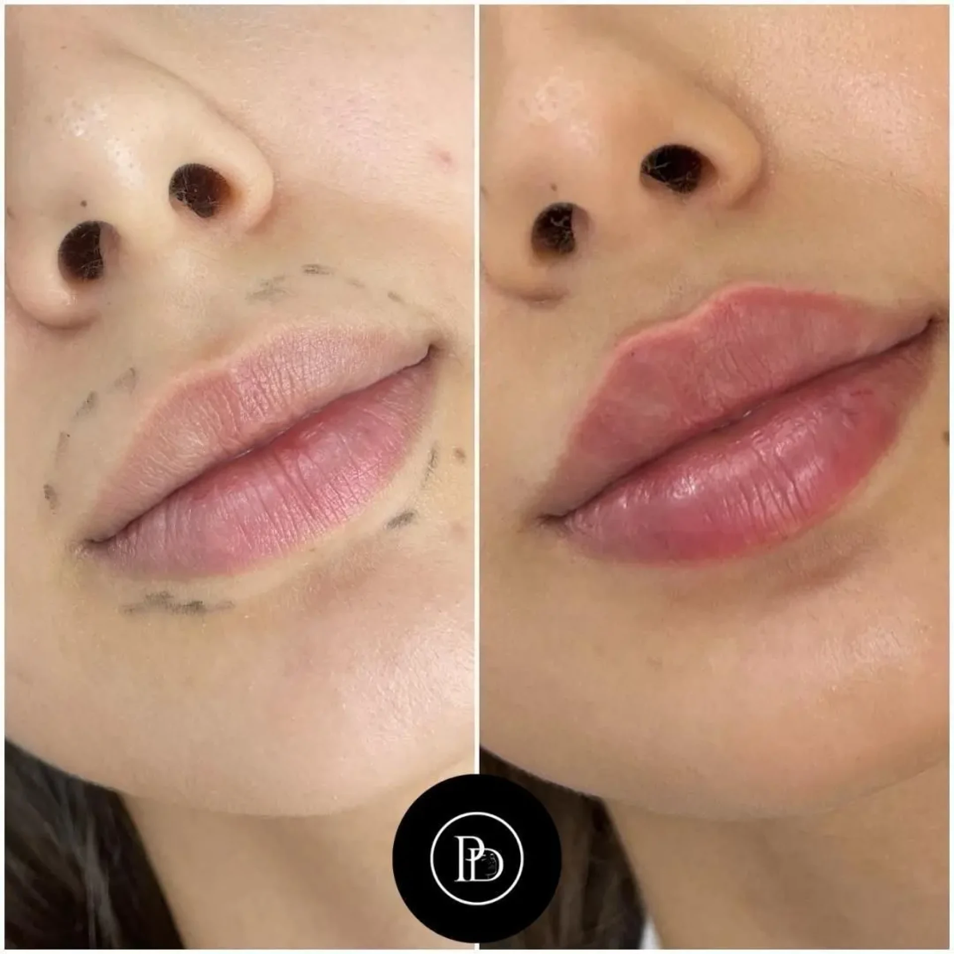 Juvederm Facial Balance by Best Doctors in dubai