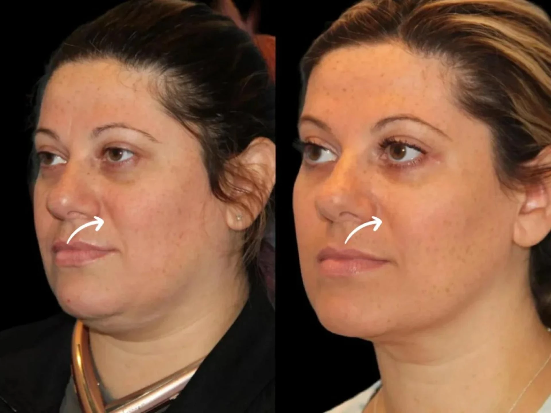 Best Doctors in Dubai on Sculptra for Hand Volume Loss
