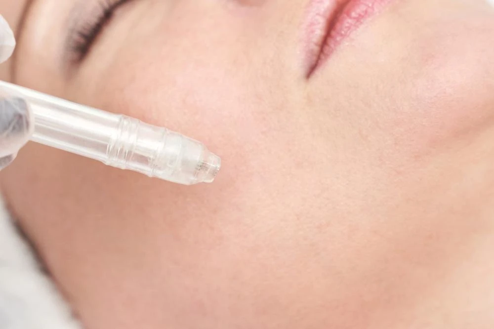 The Complete Guide to Microneedling Beverly Hills for Healthier