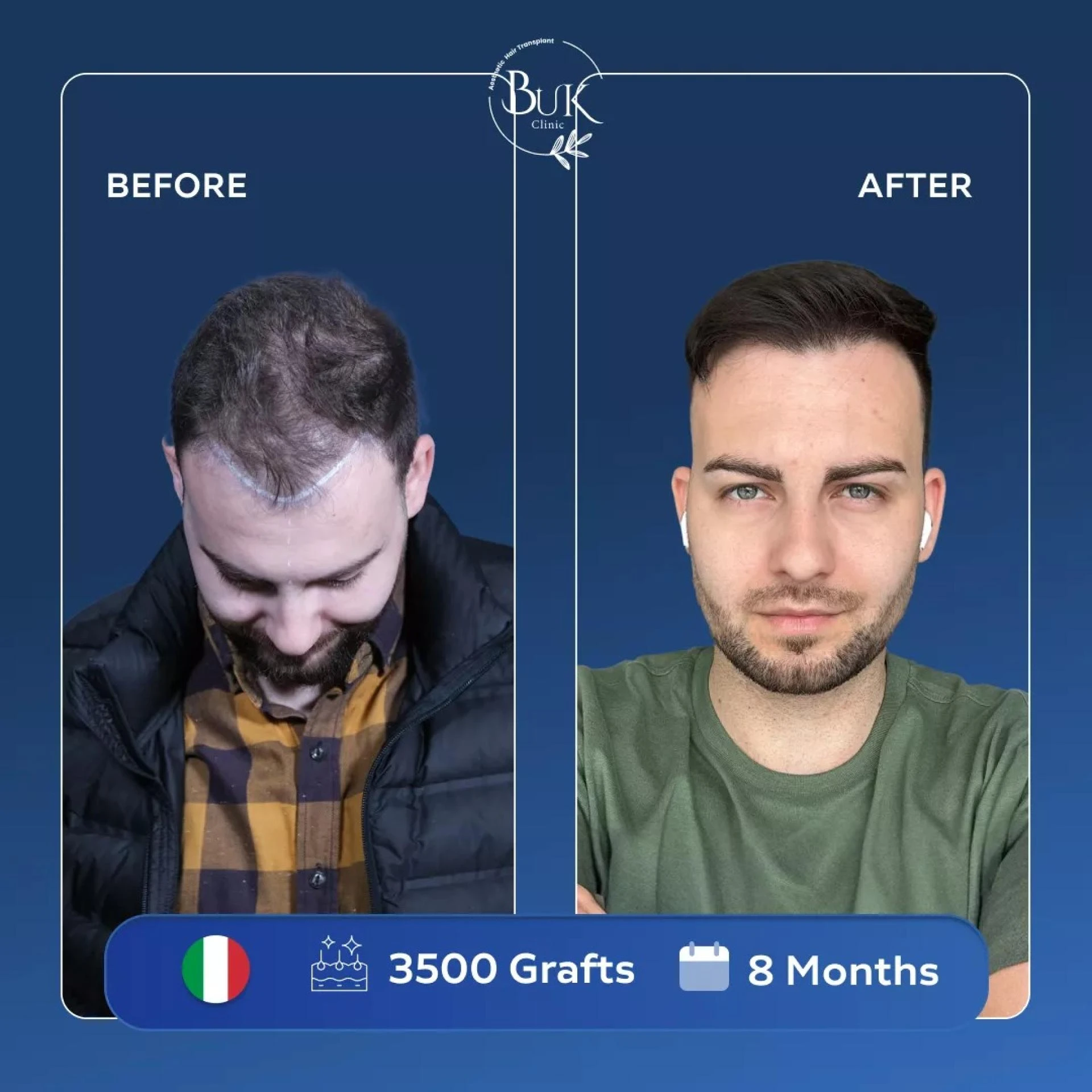 Is Hair Transplant Turkey Safe?