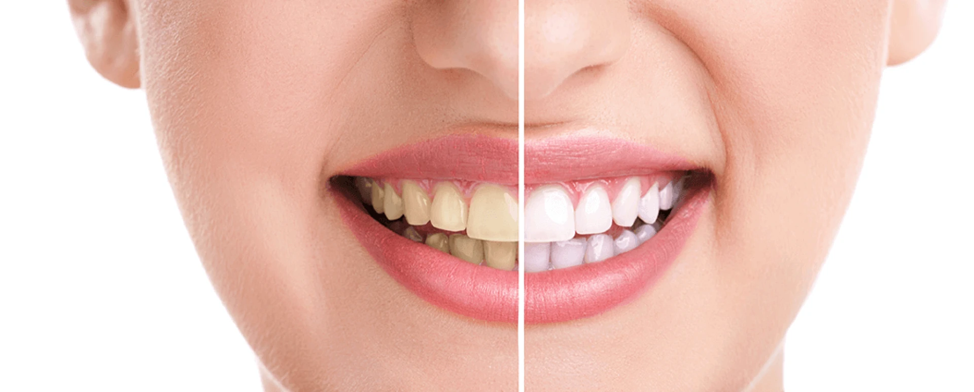 Advanced Dental Veneers Philadelphia And Gum Recession Treatment Philadelphia For Long Lasting Confident Smiles