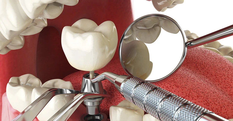 Teeth Whitening in Delhi: Safe, Fast & Long-Lasting Smile Solutions