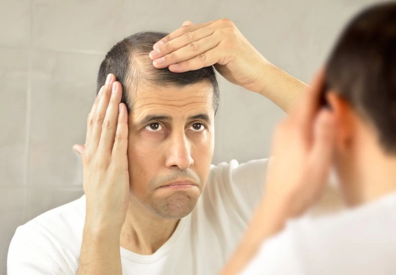 Early Hair Loss Treatment Delhi of Male Pattern Baldness for Better Results
