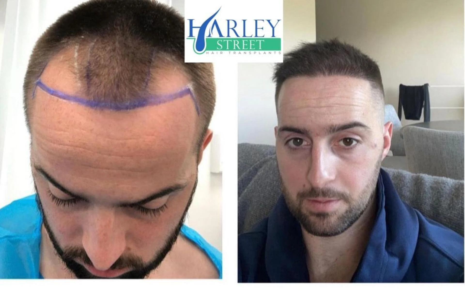 Female Hair Transplant: Benefits, Process, and Expected Results