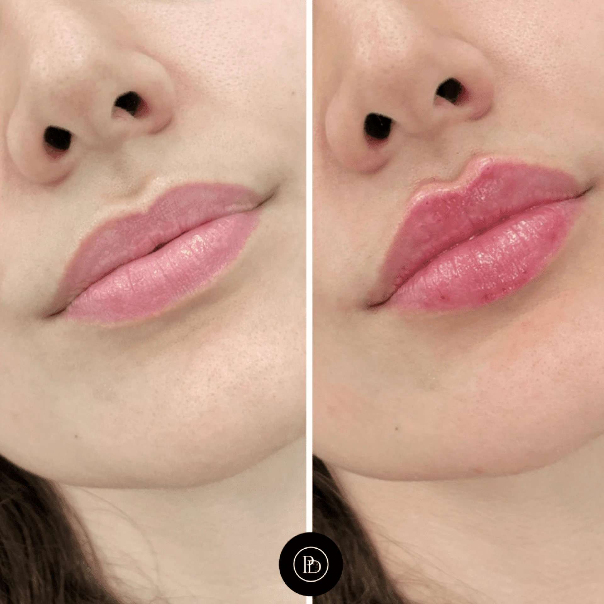 Juvederm Beauty Enhancements by the Best Doctors in Dubai
