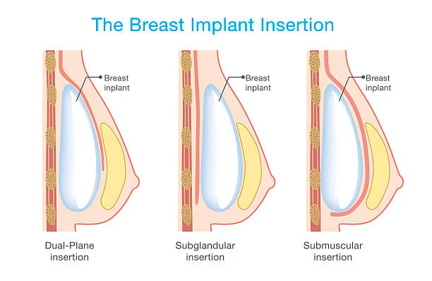 Top 6 Reasons Women Consider Changing Breast Implants (And What to Expect)