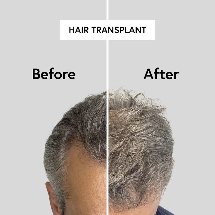Revolutionary PRP Hair Therapy in Islamabad