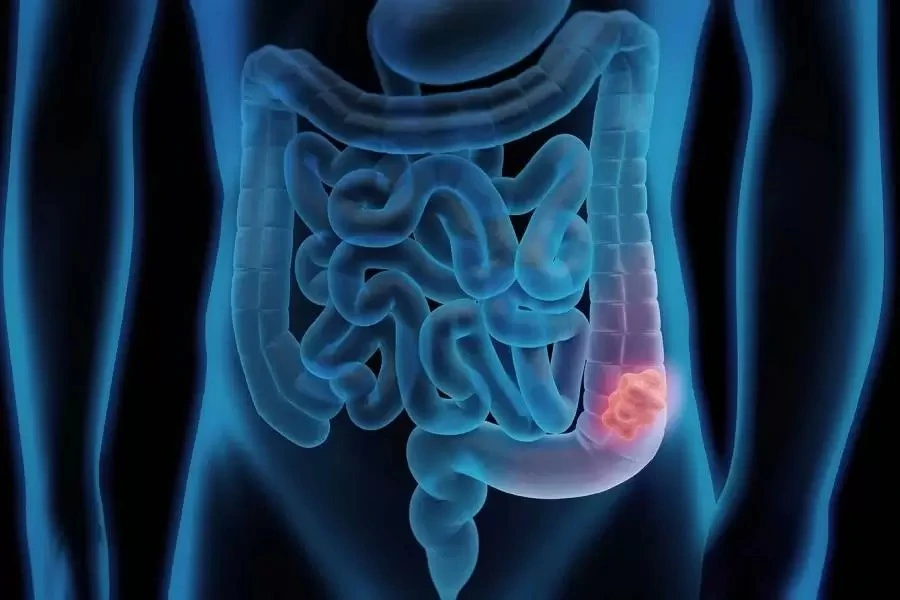 Navigating Digestive Health: Finding the Right Colorectal Surgeon in New Delhi