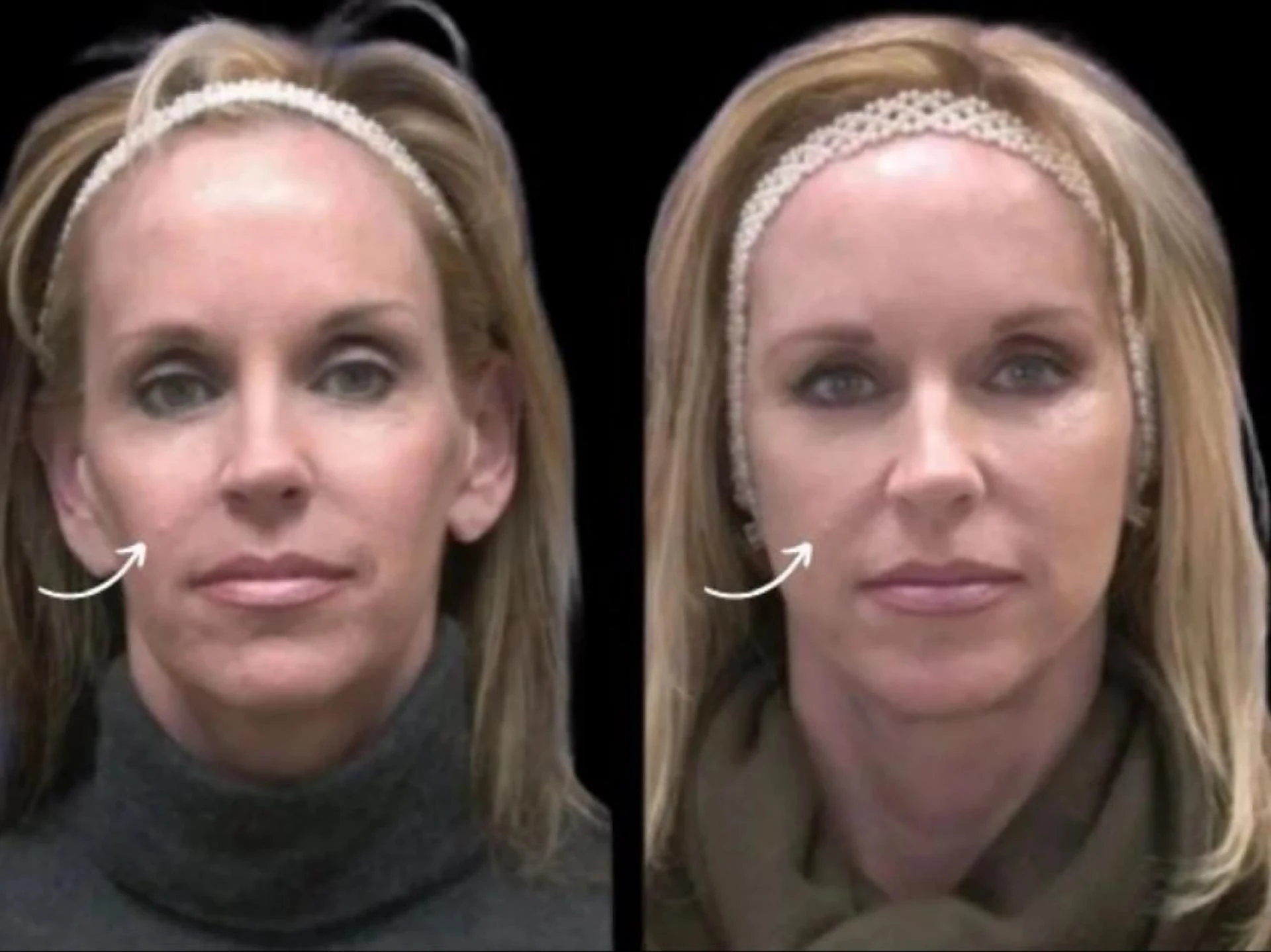 Clinic Standards for Sculptra Treatment in Dubai