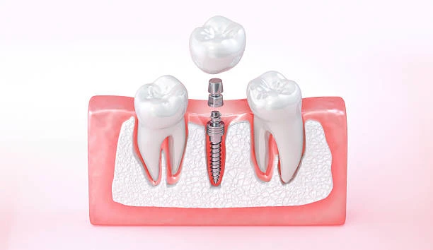 Dental Implants Brisbane: What to Eat After Surgery