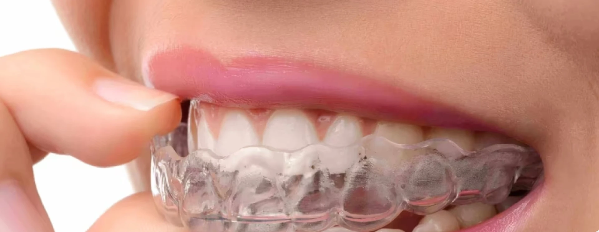 Straight Teeth Without the Fuss: What to Expect