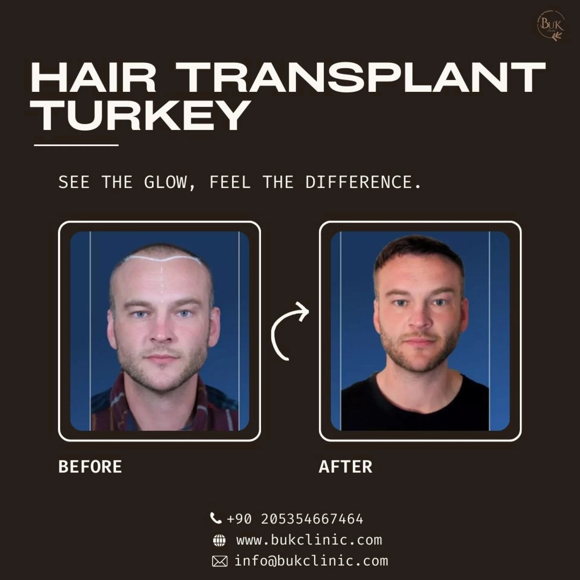 Hair Transplant Turkey: Complete Guide to Cost, Procedure, and Results