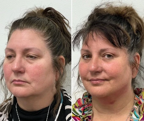 Achieve Natural-Looking Results with Under Eye Surgery in Overland Park, KS