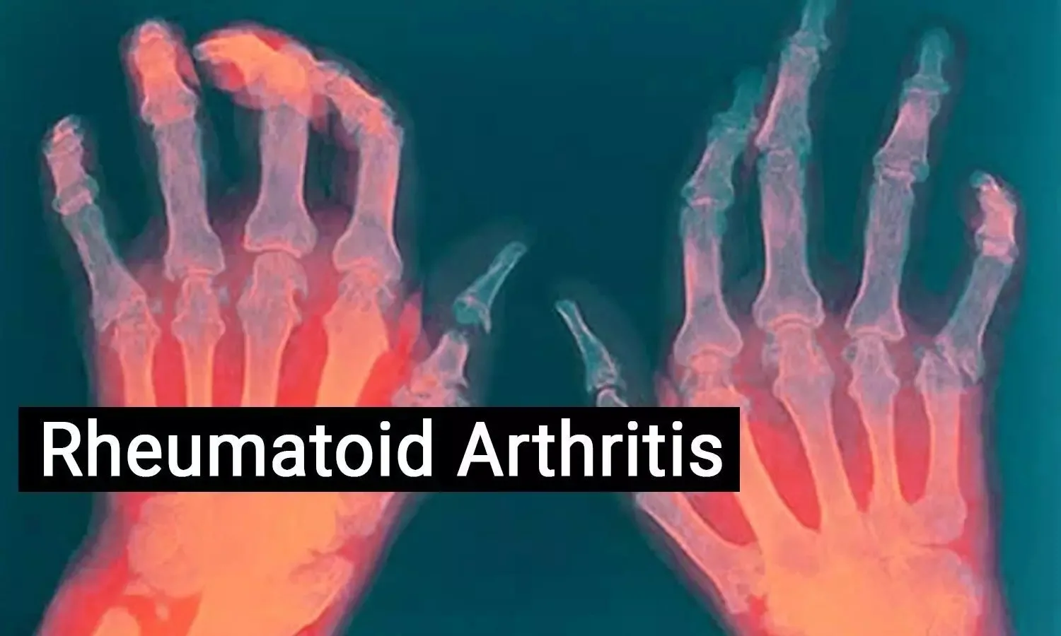 Paid Rheumatoid Arthritis Study Now Enrolling Qualified Participants