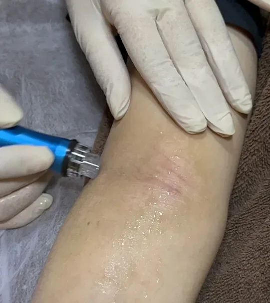 Best Eczema Treatment in Malaysia: Stop Chasing Temporary Relief and Start Healing Your Skin