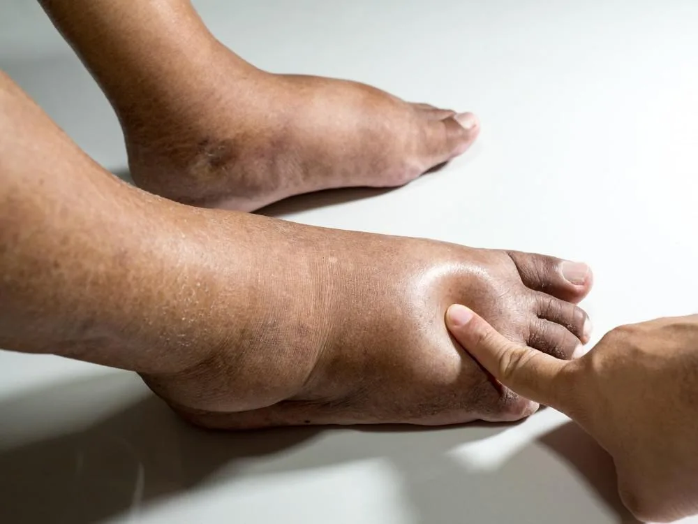 Varicose Veins Treatment Abu Dhabi for Better Vein Health