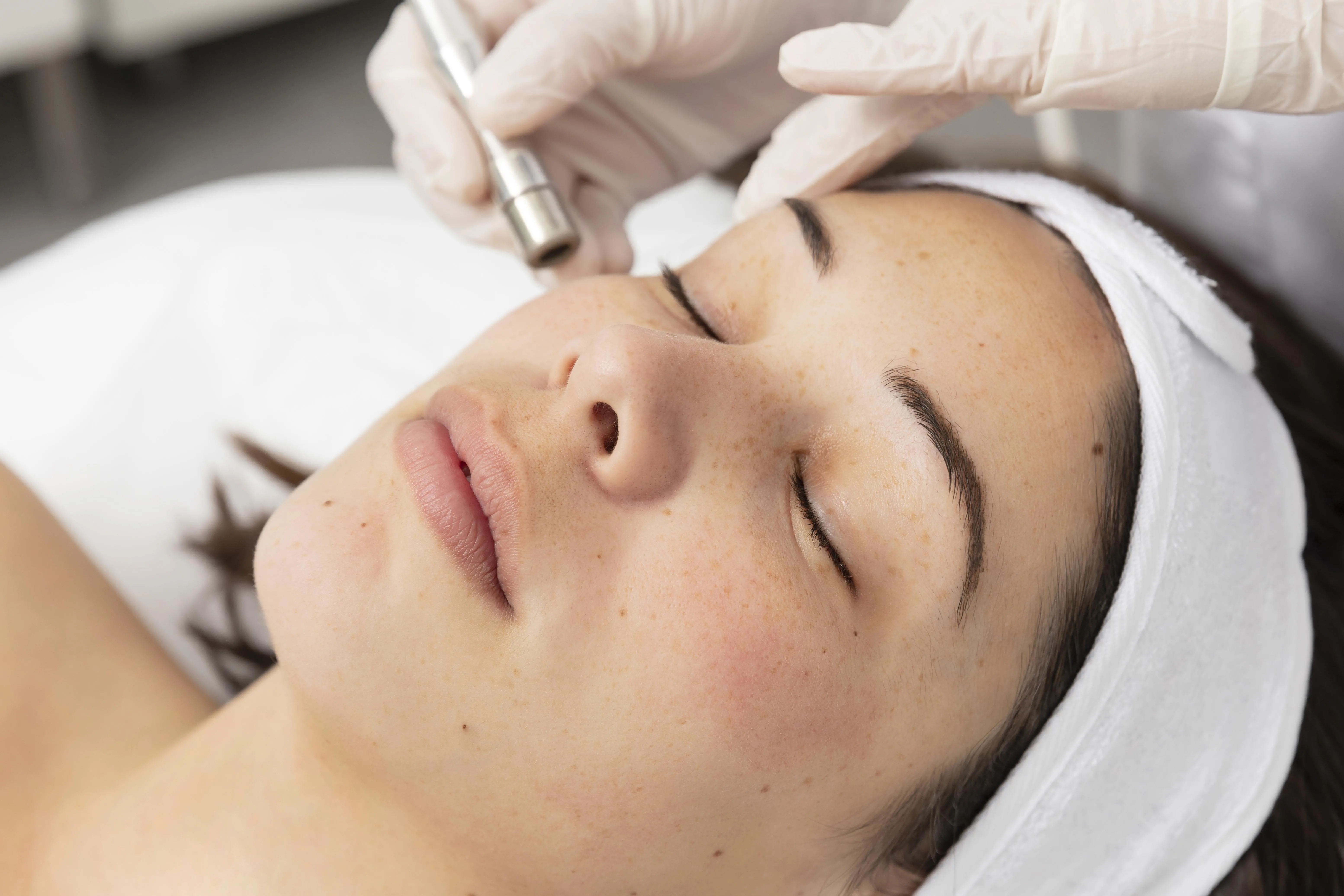Why Skin Irritation Can Make Pigmentation More Difficult to Treat
