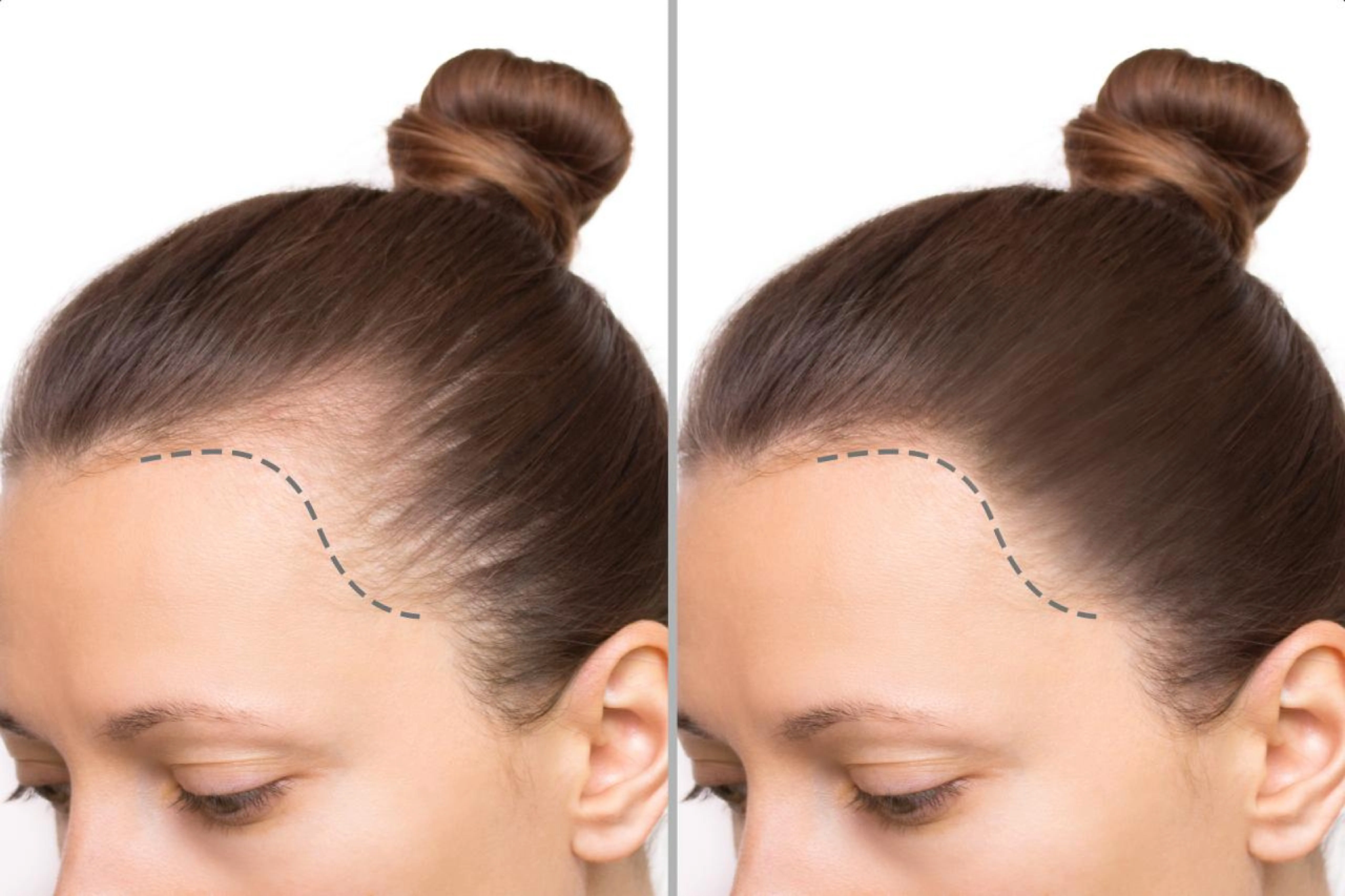 How Effective Is Hair Transplant Surgery for Women?