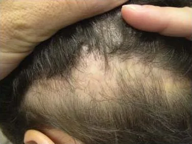 FUE Scar After a Hair Transplant? Here's What Nobody Tells You